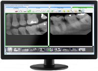 Dental X Ray